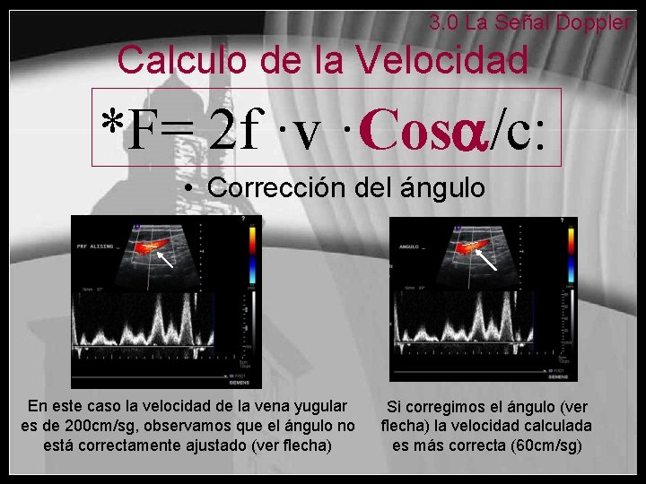 3. 0 La Señal Doppler Calculo de la Velocidad *F= 2 f ·v ·Cos