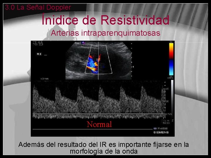 3. 0 La Señal Doppler Ínidice de Resistividad Arterias intraparenquimatosas Normal Además del resultado