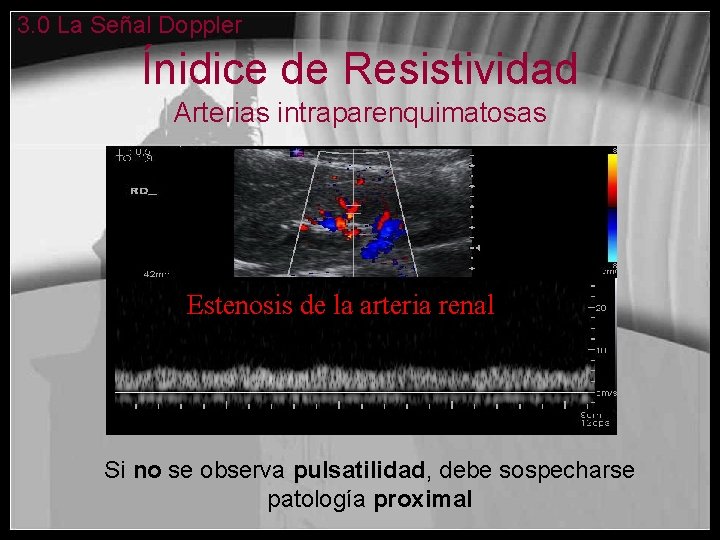 3. 0 La Señal Doppler Ínidice de Resistividad Arterias intraparenquimatosas Estenosis de la arteria