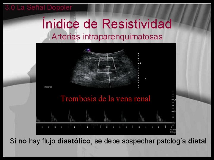 3. 0 La Señal Doppler Ínidice de Resistividad Arterias intraparenquimatosas Trombosis de la vena