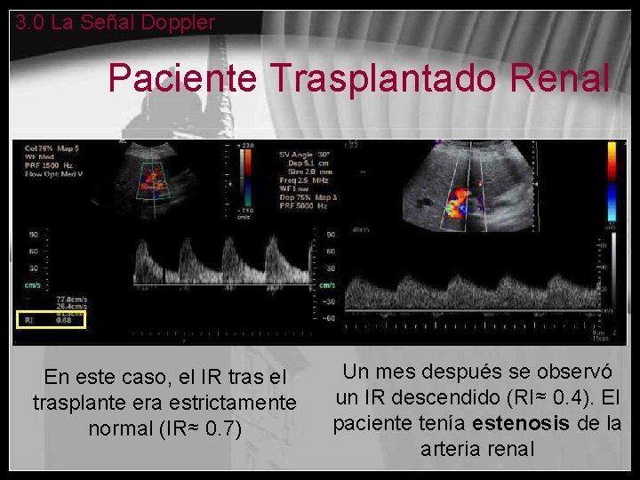 3. 0 La Señal Doppler Paciente Trasplantado Renal En este caso, el IR tras