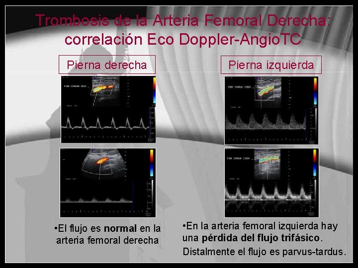 Trombosis de la Arteria Femoral Derecha: correlación Eco Doppler-Angio. TC Pierna derecha • El