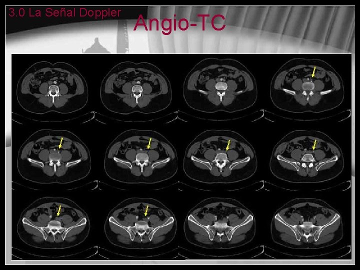 3. 0 La Señal Doppler Angio-TC 