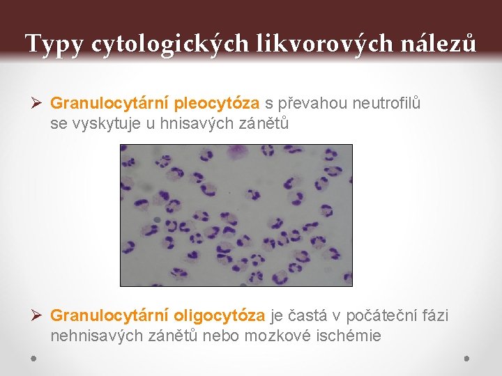 Typy cytologických likvorových nálezů Ø Granulocytární pleocytóza s převahou neutrofilů se vyskytuje u hnisavých