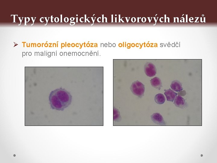 Typy cytologických likvorových nálezů Ø Tumorózní pleocytóza nebo oligocytóza svědčí pro maligní onemocnění. 