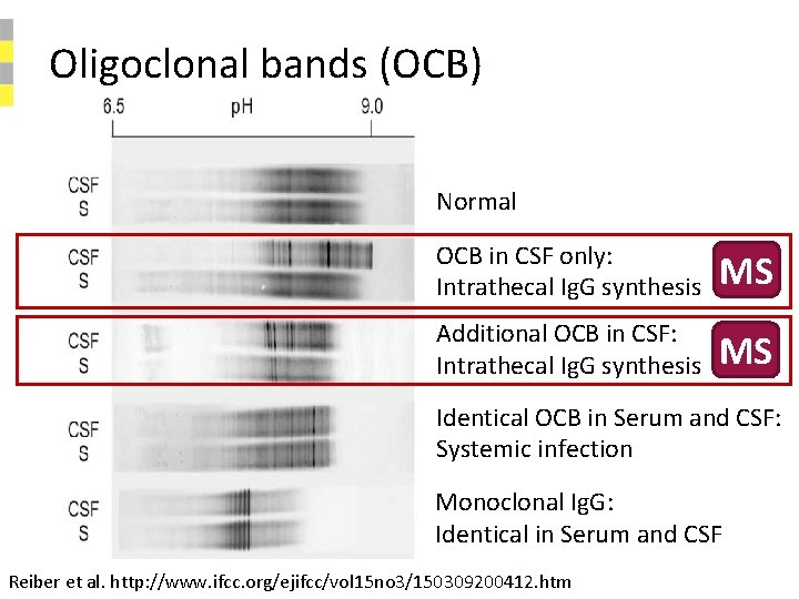 Oligoclonal bands (OCB) B C Normal OCB in CSF only: Intrathecal Ig. G synthesis