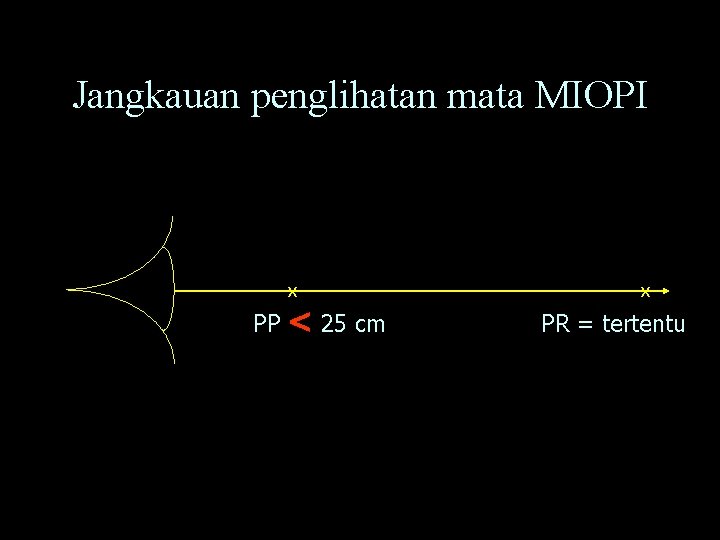 Jangkauan penglihatan mata MIOPI X PP < 25 cm X PR = tertentu 