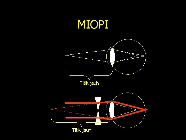 MIOPI Titik jauh 