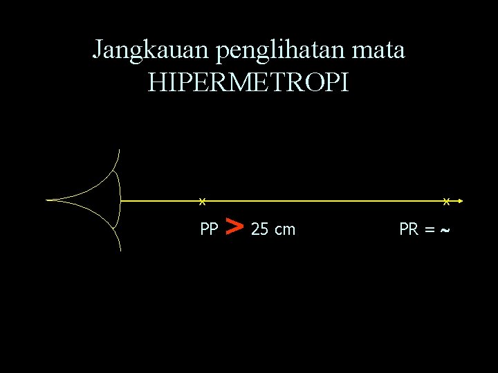 Jangkauan penglihatan mata HIPERMETROPI X PP > 25 cm X PR = 