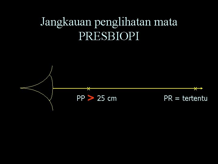 Jangkauan penglihatan mata PRESBIOPI X PP > 25 cm X PR = tertentu 
