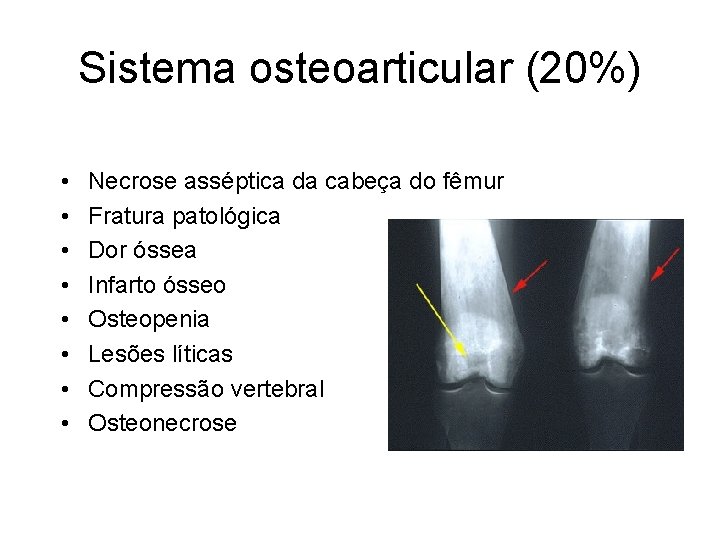 Sistema osteoarticular (20%) • • Necrose asséptica da cabeça do fêmur Fratura patológica Dor