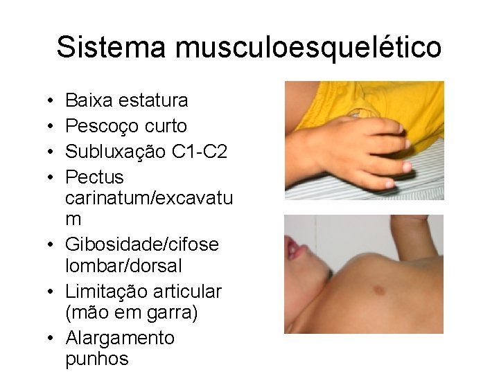 Sistema musculoesquelético • • Baixa estatura Pescoço curto Subluxação C 1 -C 2 Pectus