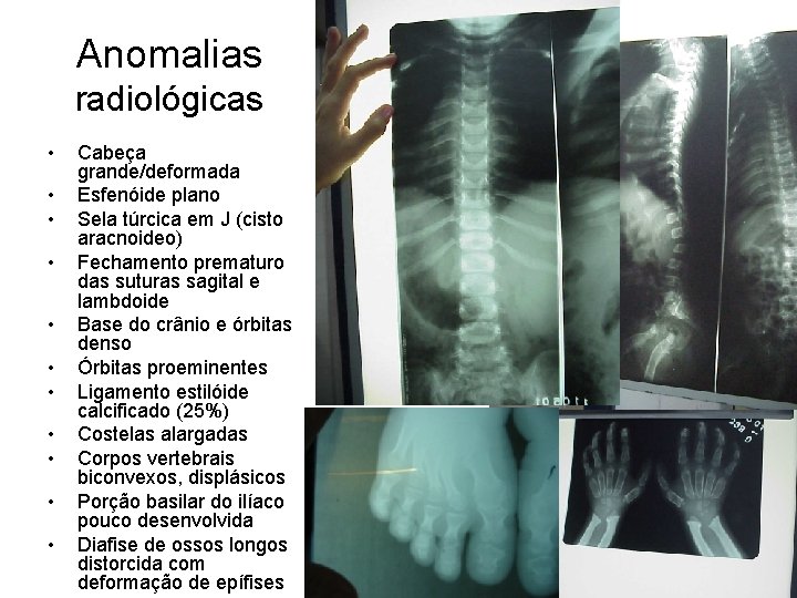 Anomalias radiológicas • • • Cabeça grande/deformada Esfenóide plano Sela túrcica em J (cisto