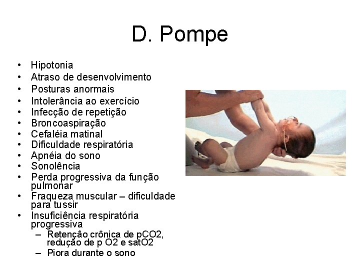 D. Pompe • • • Hipotonia Atraso de desenvolvimento Posturas anormais Intolerância ao exercício