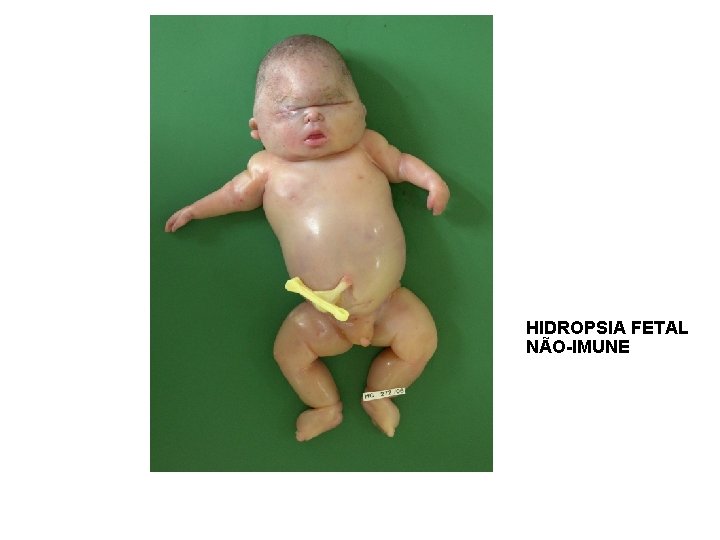 HIDROPSIA FETAL NÃO-IMUNE 