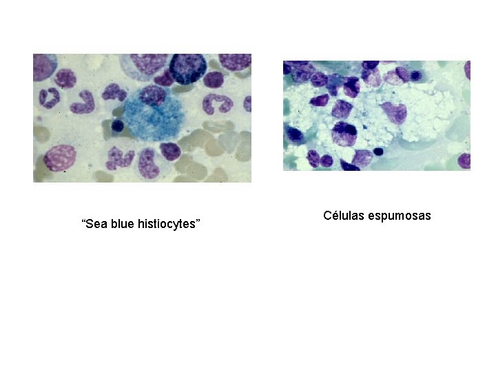 “Sea blue histiocytes” Células espumosas 