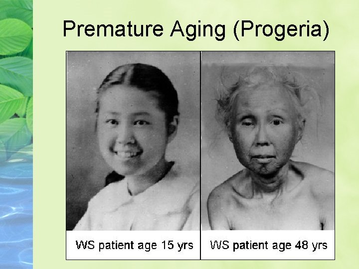 Premature Aging (Progeria) 