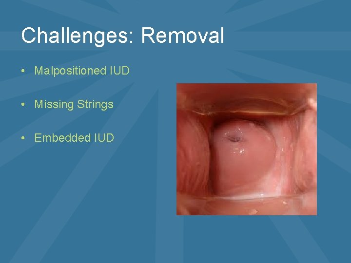 Challenges: Removal • Malpositioned IUD • Missing Strings • Embedded IUD 