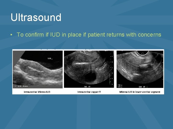 Ultrasound • To confirm if IUD in place if patient returns with concerns 