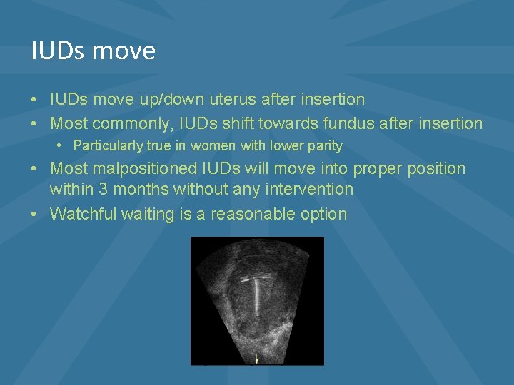 IUDs move • IUDs move up/down uterus after insertion • Most commonly, IUDs shift