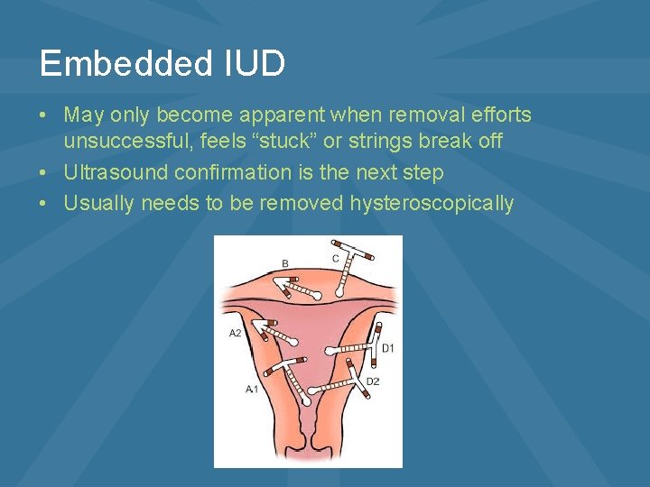 Embedded IUD • May only become apparent when removal efforts unsuccessful, feels “stuck” or