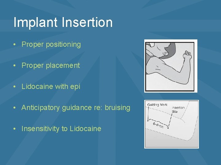 Implant Insertion • Proper positioning • Proper placement • Lidocaine with epi • Anticipatory