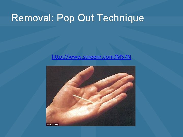 Removal: Pop Out Technique http: //www. screenr. com/MS 7 N 