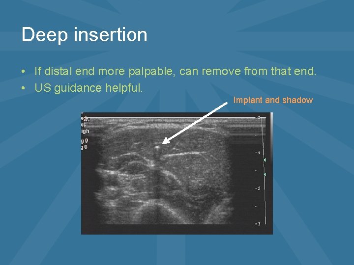 Deep insertion • If distal end more palpable, can remove from that end. •