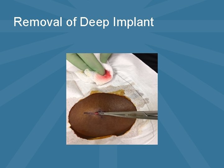 Removal of Deep Implant 