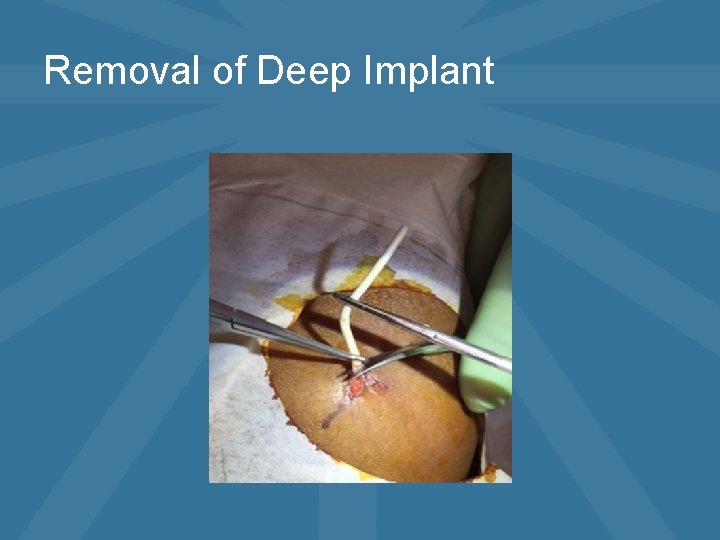 Removal of Deep Implant 