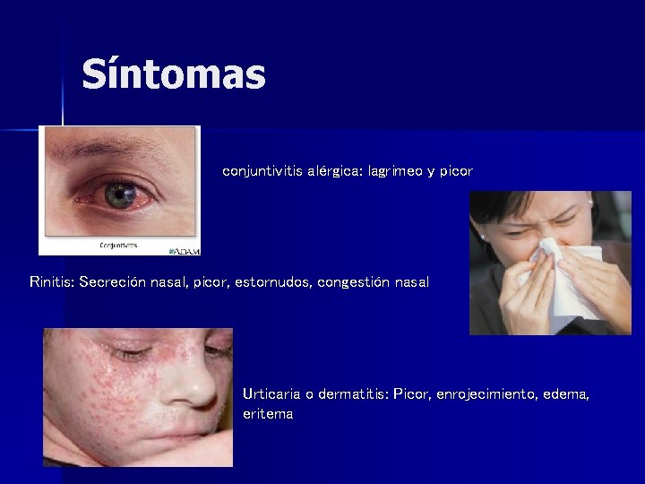 Síntomas conjuntivitis alérgica: lagrimeo y picor Rinitis: Secreción nasal, picor, estornudos, congestión nasal Urticaria