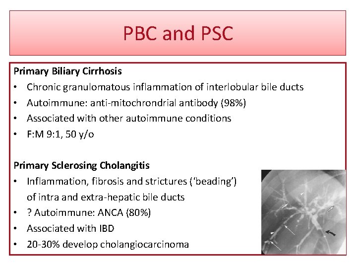 PBC and PSC Primary Biliary Cirrhosis • Chronic granulomatous inflammation of interlobular bile ducts