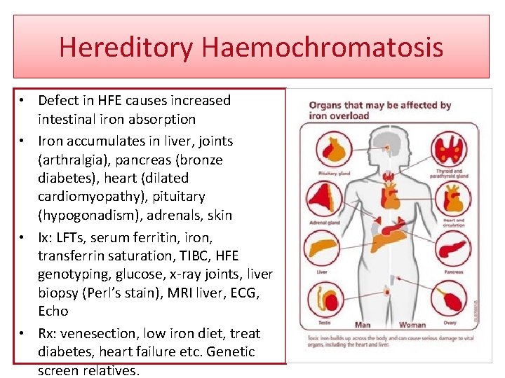 Hereditory Haemochromatosis • Defect in HFE causes increased intestinal iron absorption • Iron accumulates