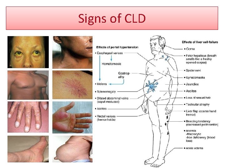 Signs of CLD 