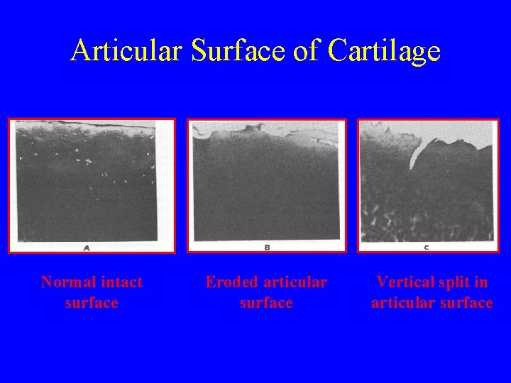 Articular Surface of Cartilage Normal intact surface Eroded articular surface Vertical split in articular