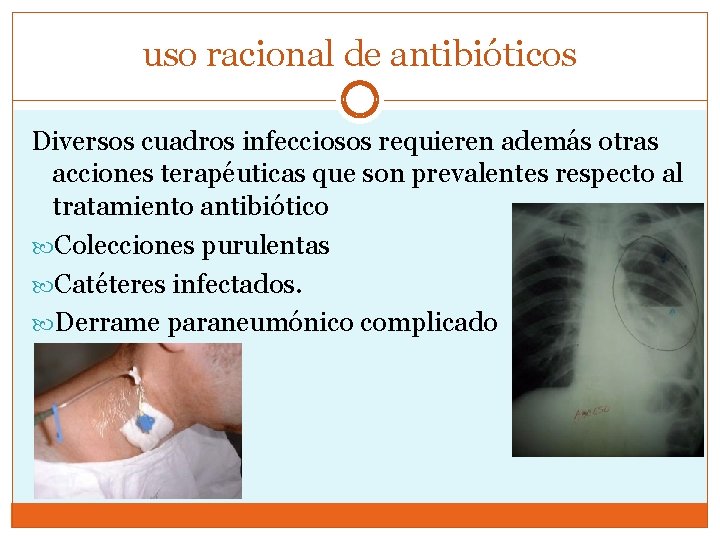 uso racional de antibióticos Diversos cuadros infecciosos requieren además otras acciones terapéuticas que son