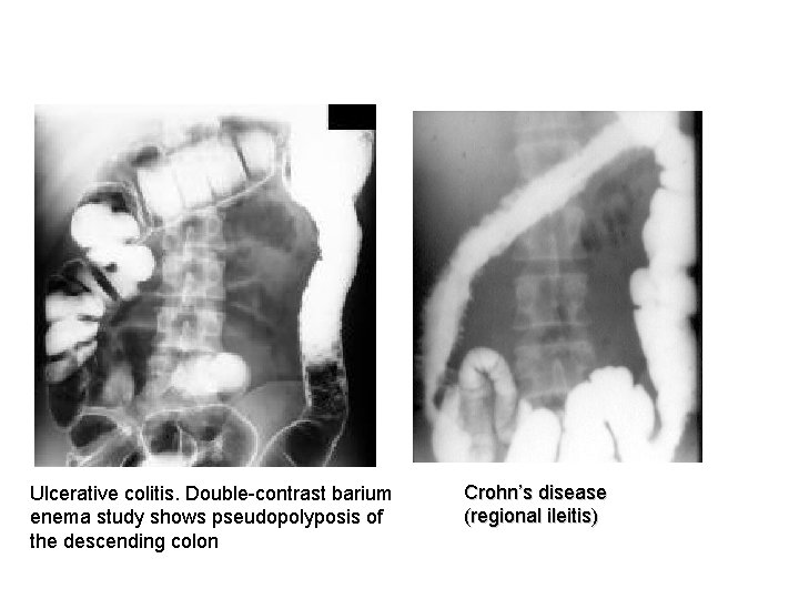 Ulcerative colitis. Double-contrast barium enema study shows pseudopolyposis of the descending colon Crohn’s disease