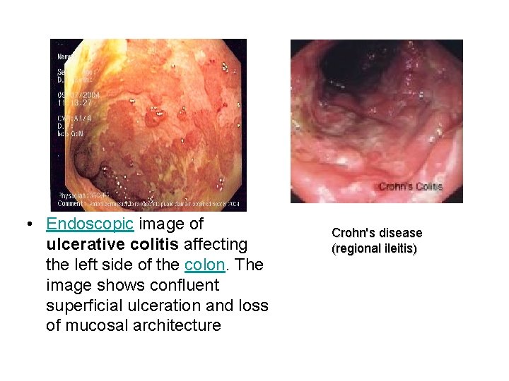  • Endoscopic image of ulcerative colitis affecting the left side of the colon.