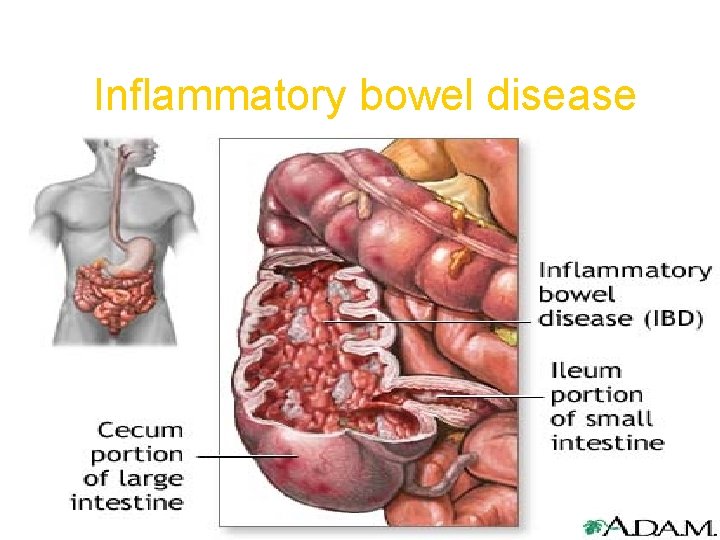 Inflammatory bowel disease 