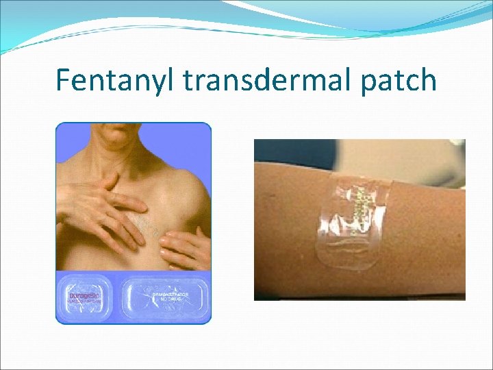 Fentanyl transdermal patch 