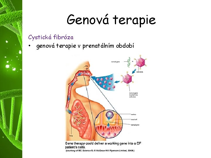 Genová terapie Cystická fibróza • genová terapie v prenatálním období 