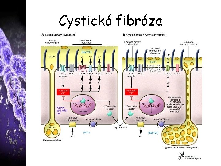 Cystická fibróza 
