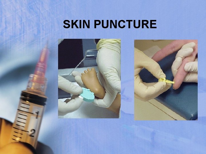 SKIN PUNCTURE 