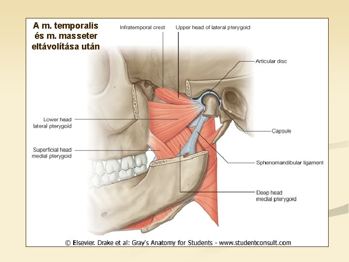 A m. temporalis és m. masseter eltávolítása után A m. temporalis és m. masseter eltávolítása után
