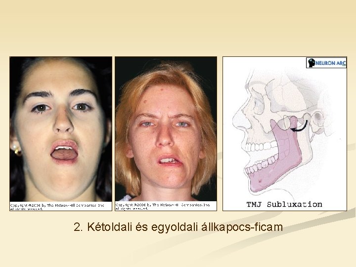2. Kétoldali és egyoldali állkapocs-ficam 2. Kétoldali és egyoldali állkapocs-ficam