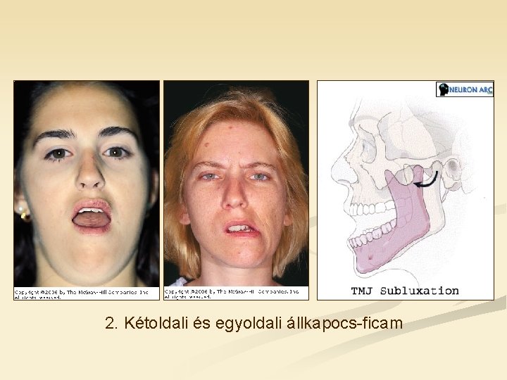 2. Kétoldali és egyoldali állkapocs-ficam 