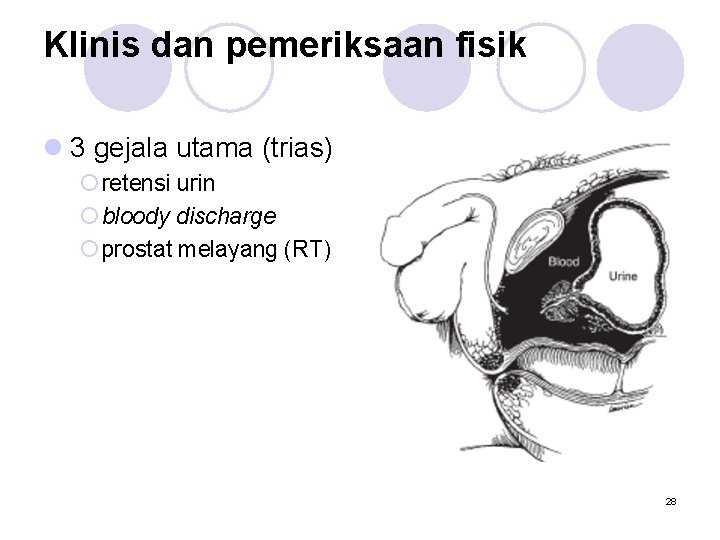 Klinis dan pemeriksaan fisik l 3 gejala utama (trias) ¡ retensi urin ¡ bloody