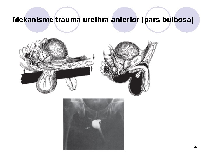 Mekanisme trauma urethra anterior (pars bulbosa) 29 