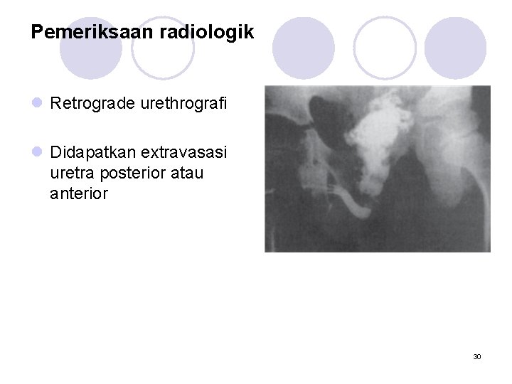 Pemeriksaan radiologik l Retrograde urethrografi l Didapatkan extravasasi uretra posterior atau anterior 30 