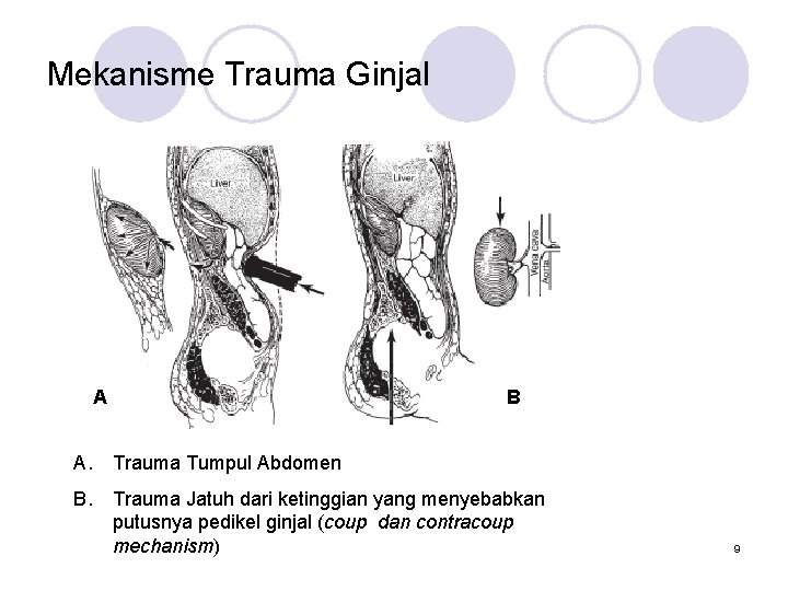 Mekanisme Trauma Ginjal A B A. Trauma Tumpul Abdomen B. Trauma Jatuh dari ketinggian